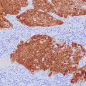 Immunohistochemistry (IHC) : Formalin-fixed, paraffin-embedded H&N invasive squamous cell carcinoma stained with anti-p16 antibody using peroxidase-conjugate and DAB chromogen.  Note the nuclear and cytoplasmic staining of tumor cells