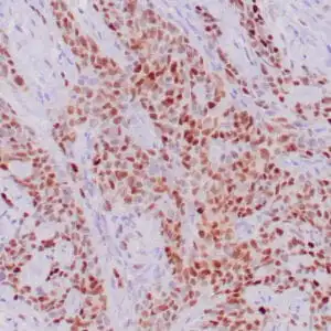 Immunohistochemistry (IHC) : Human colon adenocarcinoma stained with anti- p21 antibody using peroxidase-conjugate and DAB chromogen. Note the nuclear staining of tumor cells.