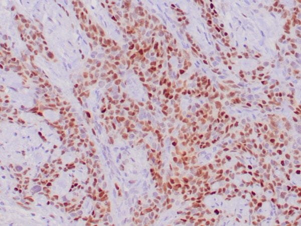 Immunohistochemistry (IHC) : Human colon adenocarcinoma stained with anti- p21 antibody using peroxidase-conjugate and DAB chromogen. Note the nuclear staining of tumor cells.