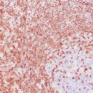Immunohistochemistry (IHC) : Human B-cell lymphoma stained with anti- p27 antibody using peroxidase-conjugate and DAB chromogen. Note nuclear staining of tumor cells.