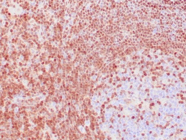 Immunohistochemistry (IHC) : Human B-cell lymphoma stained with anti- p27 antibody using peroxidase-conjugate and DAB chromogen. Note nuclear staining of tumor cells.