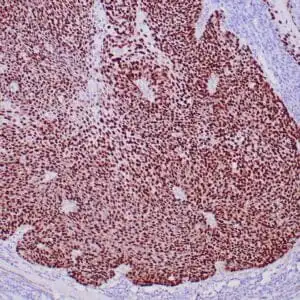 Immunohistochemistry (IHC) : Formalin-fixed, paraffin-embedded human lung squamous cell carcinoma stained with anti-p40 antibody using peroxidase-conjugate and DAB chromogen. Note the nuclear staining of tumor cells.
