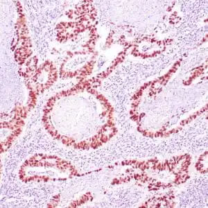 Immunohistochemistry (IHC) : Human breast carcinoma infiltrating fat stained with anti-p53 antibody using peroxidase-conjugate and DAB chromogen. Note the nuclear staining of carcinoma cells.