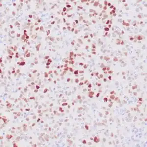 Immunohistochemistry (IHC) : Human colon carcinoma infiltrating fat stained with anti-p53 antibody using peroxidase-conjugate and DAB chromogen. Note the nuclear staining of carcinoma cells.