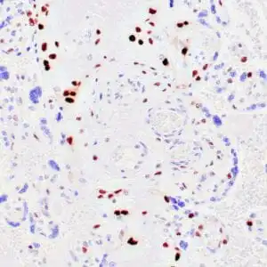 Immunohistochemistry (IHC) : Human partial mole stained with anti-p57 antibody using peroxidase-conjugate and DAB chromogen.  Note the nuclear staining of cytotrophoblasts in partial mole.