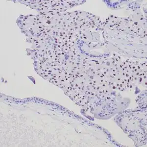 Immunohistochemistry (IHC) : Formalin-fixed, paraffin-embedded human complete moles stained with anti-p57 antibody