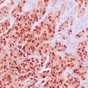 Immunohistochemistry (IHC) : Human thyroid carcinoma stained with anti-PAX-8 antibody using peroxidase-conjugate and DAB chromogen. Note nuclear stain of tumor cells.