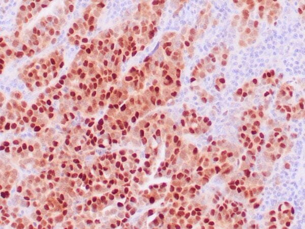 Immunohistochemistry (IHC) : Human thyroid carcinoma stained with anti-PAX-8 antibody using peroxidase-conjugate and DAB chromogen. Note nuclear stain of tumor cells.