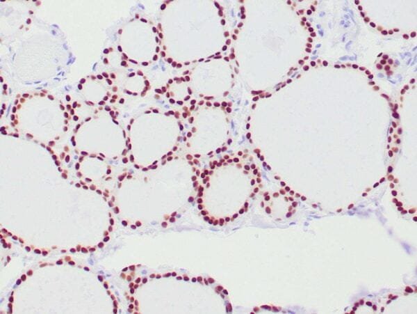 Immunohistochemistry (IHC) : Human thyroid gland stained with anti-PAX-8 antibody using peroxidase-conjugate and DAB chromogen. Note nuclear stain of follicular cells.