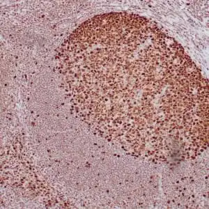 Immunohistochemistry (IHC) : Formalin-fixed, paraffin-embedded human tonsil stained with anti-PCNA antibody using peroxidase-conjugate and DAB chromogen. Note the nuclear staining of follicular center cells
