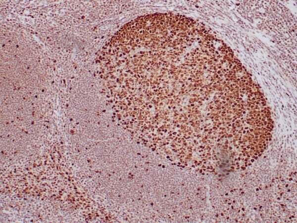 Immunohistochemistry (IHC) : Formalin-fixed, paraffin-embedded human tonsil stained with anti-PCNA antibody using peroxidase-conjugate and DAB chromogen. Note the nuclear staining of follicular center cells