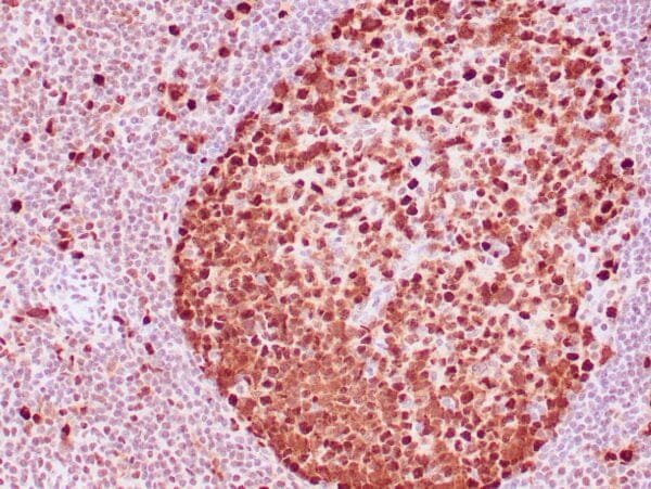 Immunohistochemistry (IHC) : Human tonsil stained with anti-PCNA antibody using peroxidase-conjugate and DAB chromogen. Note the nuclear staining of lymphoid cells.