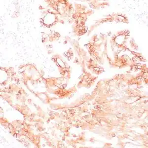 Immunohistochemistry (IHC) : Human lung adenocarcinoma stained with anti-PD-L1 (Clone ZR3) using peroxidase-conjugate and DAB chromogen. Note membranous staining of tumor cells.