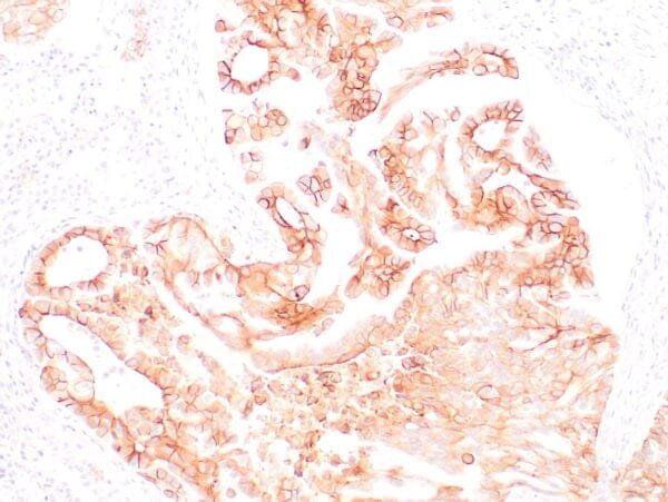 Immunohistochemistry (IHC) : Human lung adenocarcinoma stained with anti-PD-L1 (Clone ZR3) using peroxidase-conjugate and DAB chromogen. Note membranous staining of tumor cells.