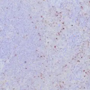 Immunohistochemistry (IHC) : Formalin-fixed, paraffin-embedded human spleen stained with anti-perforin antibody using peroxidase-conjugate and DAB chromogen. Note the cytoplasmic granular staining of cytotoxic T cells