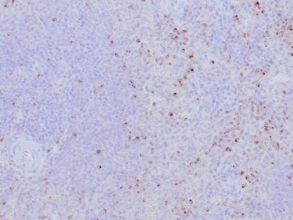 Immunohistochemistry (IHC) : Formalin-fixed, paraffin-embedded human spleen stained with anti-perforin antibody using peroxidase-conjugate and DAB chromogen. Note the cytoplasmic granular staining of cytotoxic T cells