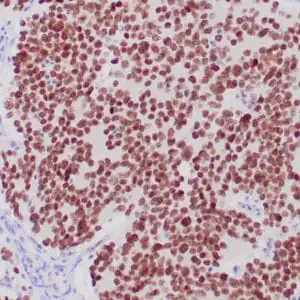 Immunohistochemistry (IHC) : Formalin-fixed, paraffin-embedded human neuroblastoma stained with anti-PHOX2B antibody using peroxidase-conjugate and DAB chromogen. Note nuclear staining of tumor cells