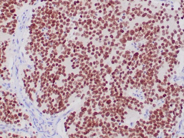 Immunohistochemistry (IHC) : Formalin-fixed, paraffin-embedded human neuroblastoma stained with anti-PHOX2B antibody using peroxidase-conjugate and DAB chromogen. Note nuclear staining of tumor cells