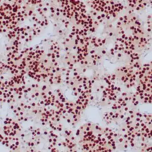 Immunohistochemistry (IHC) : Formalin-fixed, paraffin-embedded human pituitary stained with anti-PIT-1 antibody using peroxidase-conjugate and DAB chromogen. Note strong nuclear staining of glandular cells