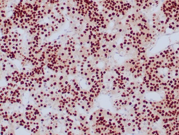 Immunohistochemistry (IHC) : Formalin-fixed, paraffin-embedded human pituitary stained with anti-PIT-1 antibody using peroxidase-conjugate and DAB chromogen. Note strong nuclear staining of glandular cells