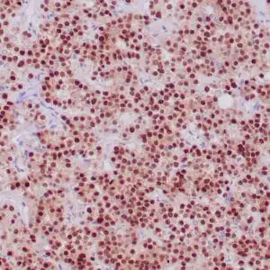 Immunohistochemistry (IHC) : Formalin-fixed, paraffin-embedded human pituitary stained with anti-PIT-1 antibody using peroxidase-conjugate and DAB chromogen. Note strong nuclear staining of glandular cells