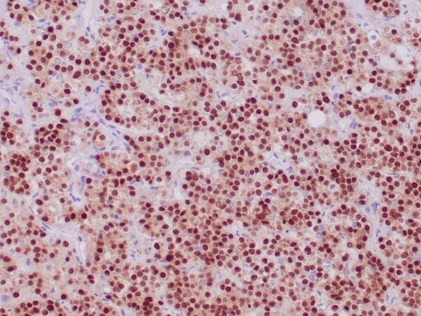 Immunohistochemistry (IHC) : Formalin-fixed, paraffin-embedded human pituitary stained with anti-PIT-1 antibody using peroxidase-conjugate and DAB chromogen. Note strong nuclear staining of glandular cells