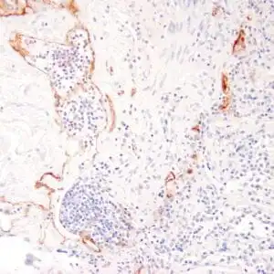 Immunohistochemistry (IHC) : Human lymph node stained with anti-podoplannin antibody using peroxidase-conjugate and DAB chromogen. Note cytoplasmic staining of lymphatic endothelial cells..
