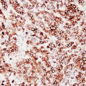 Immunohistochemistry (IHC) : Human testicular seminoma stained with anti-D2-40 antibody using peroxidase-conjugate and DAB chromogen. Note cytoplasmic staining of tumor cells and endothelial cells of lymphatic channels.