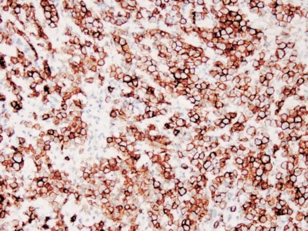 Immunohistochemistry (IHC) : Human testicular seminoma stained with anti-D2-40 antibody using peroxidase-conjugate and DAB chromogen. Note cytoplasmic staining of tumor cells and endothelial cells of lymphatic channels.