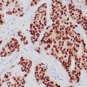 Immunohistochemistry (IHC) : Formalin-fixed, paraffin-embedded human breast carcinoma stained with anti-PR antibody using peroxidase-conjugate and DAB chromogen. Note the nuclear staining of tumor cells