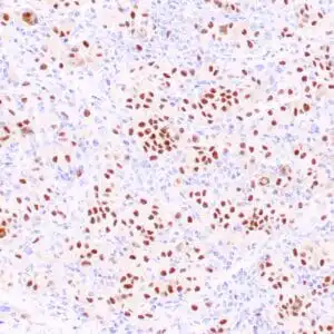 Immunohistochemistry (IHC) : Formalin-fixed, paraffin-embedded human liver with metastatic melanoma stained with anti-PRAME antibody using peroxidase-conjugate and DAB chromogen. Note the nuclear staining in tumor cells