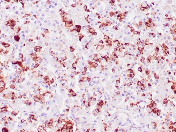 Immunohistochemistry (IHC) : Human pituitary gland stained with anti-Prolactin antibody using peroxidase-conjugate and DAB chromogen. Note cytoplasmic staining of some glandular cells.