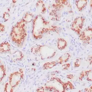Immunohistochemistry (IHC) : Human prostatic tissue stained with anti-Prostein antibody using peroxidase-conjugate and DAB chromogen. Note the cytoplasmic staining of benign prostate glands.