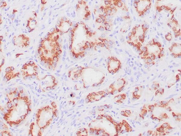 Immunohistochemistry (IHC) : Human prostatic tissue stained with anti-Prostein antibody using peroxidase-conjugate and DAB chromogen. Note the cytoplasmic staining of benign prostate glands.