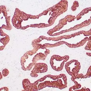Immunohistochemistry (IHC) : Human prostate stained with anti-PSAP antibody using peroxidase-conjugate and DAB chromogen. Note the cytoplasmic staining of benign prostate glands.