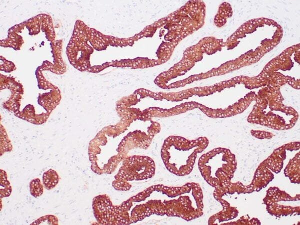 Immunohistochemistry (IHC) : Human prostate stained with anti-PSAP antibody using peroxidase-conjugate and DAB chromogen. Note the cytoplasmic staining of benign prostate glands.