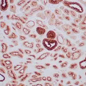 Immunohistochemistry (IHC) : Human prostate stained with anti-PSAP antibody using peroxidase-conjugate and DAB chromogen. Note the cytoplasmic staining of benign prostate glands.