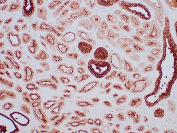 Immunohistochemistry (IHC) : Human prostate stained with anti-PSAP antibody using peroxidase-conjugate and DAB chromogen. Note the cytoplasmic staining of benign prostate glands.