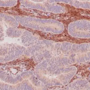 Immunohistochemistry (IHC) : Formalin-fixed, paraffin-embedded human endometrioid adenocarcinoma stained with anti-PTEN using peroxidase-conjugate and DAB chromogen. Note carcinoma is negative whereas stromal cells are positive
