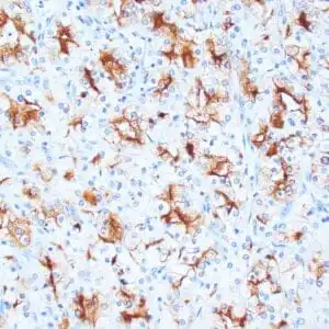 Immunohistochemistry (IHC) : Human clear cell renal cell carcinoma stained with anti-RCC antibody using peroxidase-conjugate and DAB chromogen. Note the cytoplasmic and Golgi staining of tumor cells.