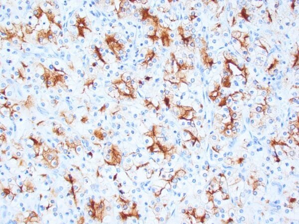 Immunohistochemistry (IHC) : Human clear cell renal cell carcinoma stained with anti-RCC antibody using peroxidase-conjugate and DAB chromogen. Note the cytoplasmic and Golgi staining of tumor cells.