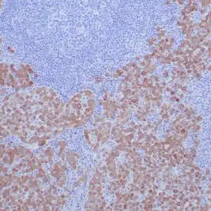 Immunohistochemistry (IHC) : Formalin-fixed, paraffin-embedded human node with metastatic lung adenocarcinoma stained with anti-ROS1 antibody using peroxidase-conjugate and DAB chromogen. Note cytoplasmic staining of tumor cells