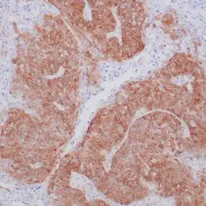 Immunohistochemistry (IHC) : Formalin-fixed and paraffin-embedded human head and neck small cell carcinoma stained with anti-RRM1 antibody using peroxidase-conjugate and DAB chromogen. Note the cytoplasmic staining of tumor cells