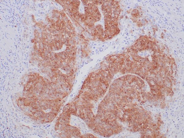 Immunohistochemistry (IHC) : Formalin-fixed and paraffin-embedded human head and neck small cell carcinoma stained with anti-RRM1 antibody using peroxidase-conjugate and DAB chromogen. Note the cytoplasmic staining of tumor cells