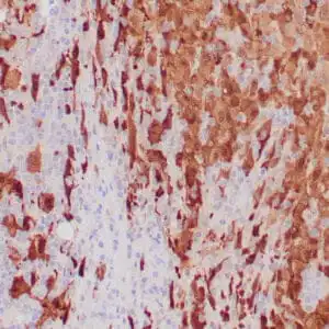 Immunohistochemistry (IHC) : Human melanoma stained with anti-S-100 antibody using peroxidase0conjugate and DAB chromogen. Note intense nuclear and cytoplasmic staining of melanoma cells.