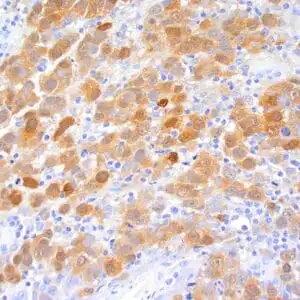 Immunohistochemistry (IHC) : Formalin-fixed, paraffin-embedded human melanoma stained with anti-S-100B antibody using peroxidase conjugate and DAB chromogen. Note intense nuclear and cytoplasmic staining of melanoma cells