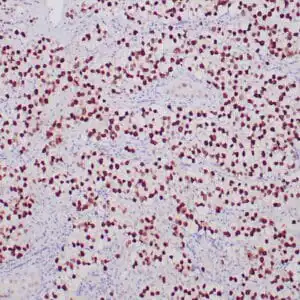 Immunohistochemistry (IHC) : Formalin-fixed, paraffin-embedded human seminoma stained with anti-SALL4 antibody using peroxidase-conjugate and DAB chromogen. Note nuclear staining of tumor cells