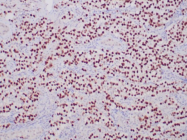 Immunohistochemistry (IHC) : Formalin-fixed, paraffin-embedded human seminoma stained with anti-SALL4 antibody using peroxidase-conjugate and DAB chromogen. Note nuclear staining of tumor cells