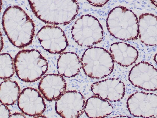 Immunohistochemistry (IHC) : Formalin-fixed, paraffin-embedded human colon stained with anti-SATB2 antibody using peroxidase-conjugate and DAB chromogen. Note nuclear staining of glandular cells