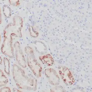 Immunohistochemistry (IHC) : Formalin-fixed, paraffin-embedded succinate dehydrogenase deficient RCC stained with anti-SDHB antibody using peroxidase-conjugate and DAB chromogen. Note the cytoplasmic staining of tumor cells